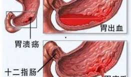 胃出血可以吃胜瓜吗,胃出血患者适宜食用胜瓜的饮食建议