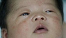 小儿湿疹吃瓜,呵护宝宝湿疹肌肤
